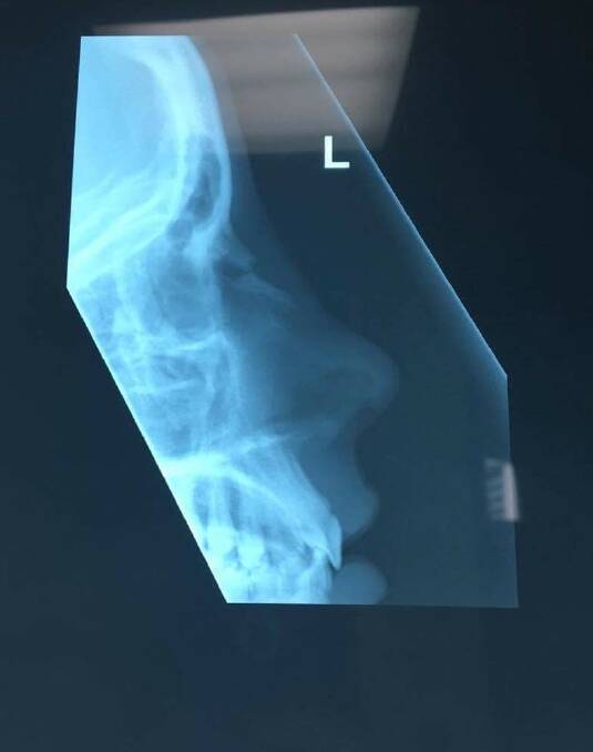 No good: Jess Eaton's x-ray of her broken nose.
